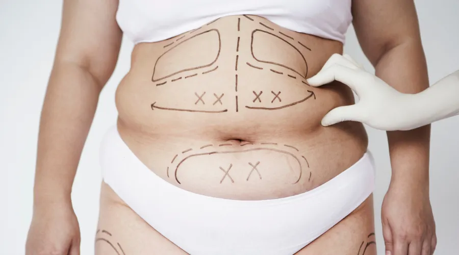 Abdomen marked for cosmetic surgery with dashed outlines and Xs; a gloved hand touches the skin.",