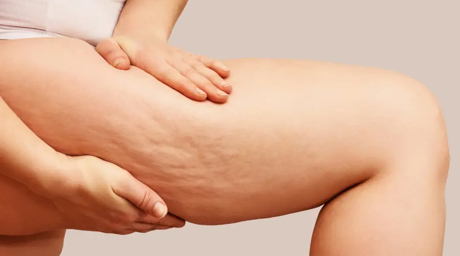 Close-up of a hand massaging a thigh with visible cellulite and dimples on the skin, neutral background.