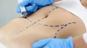 Surgeon in blue gloves marks a patient’s abdomen with dotted lines before a cosmetic procedure.