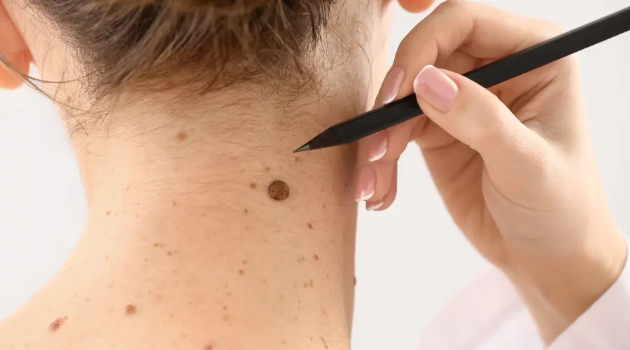Back of a neck with a brown mole being examined by a hand holding a black pen-like instrument.